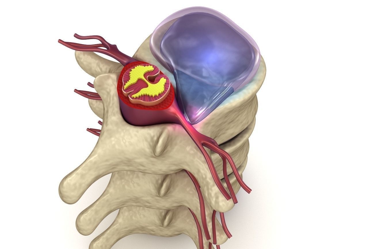 Hernaited  disc in human spine in details  3D model_4