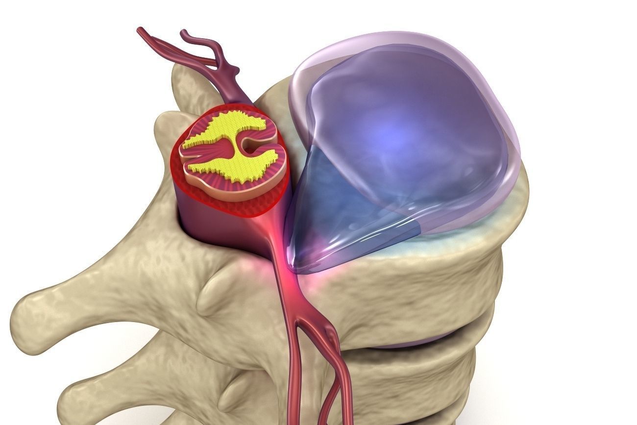 Hernaited  disc in human spine in details  3D model_9