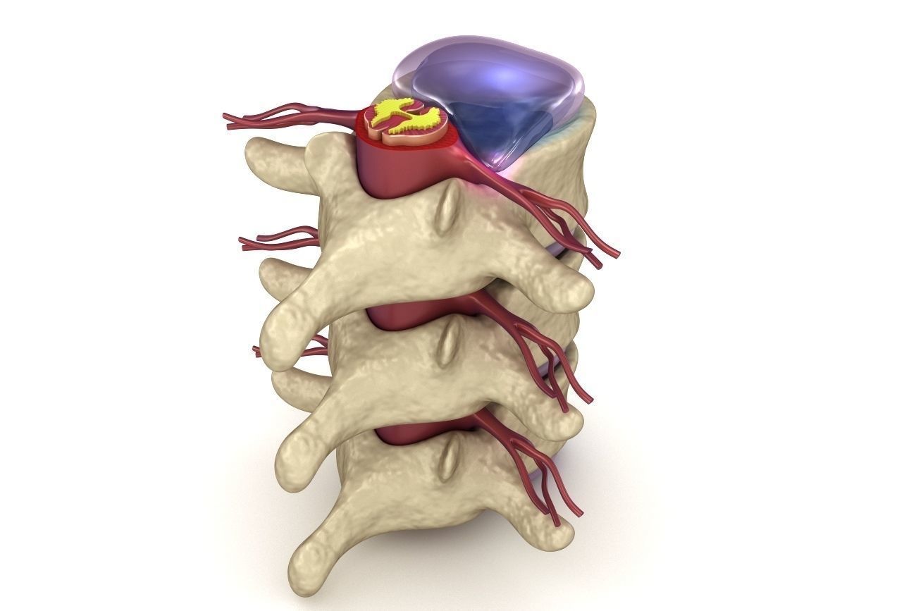 Hernaited  disc in human spine in details  3D model_7