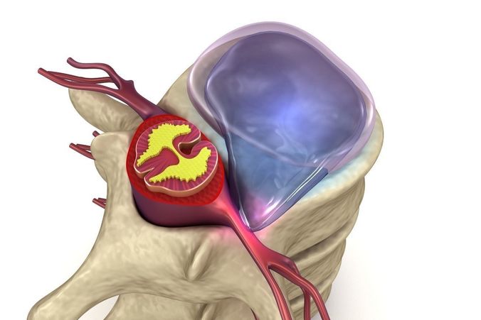 Hernaited  disc in human spine in details  3D model