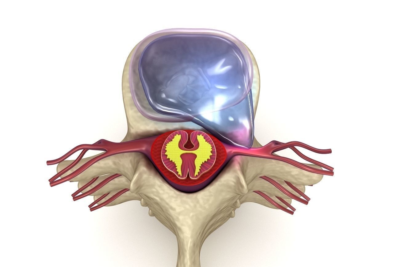 Hernaited  disc in human spine in details  3D model_3