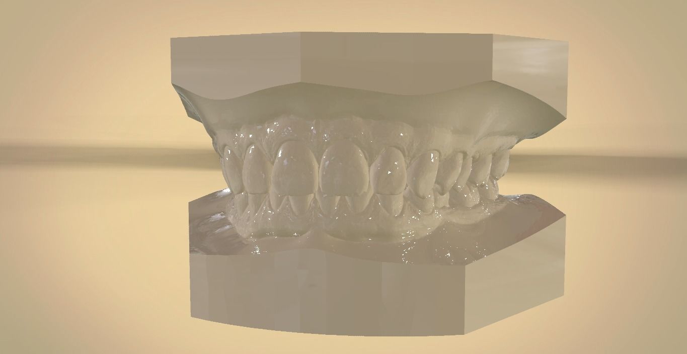 Digital Orthodontic Study Models with Virtual ABO Bases 3D print model_15