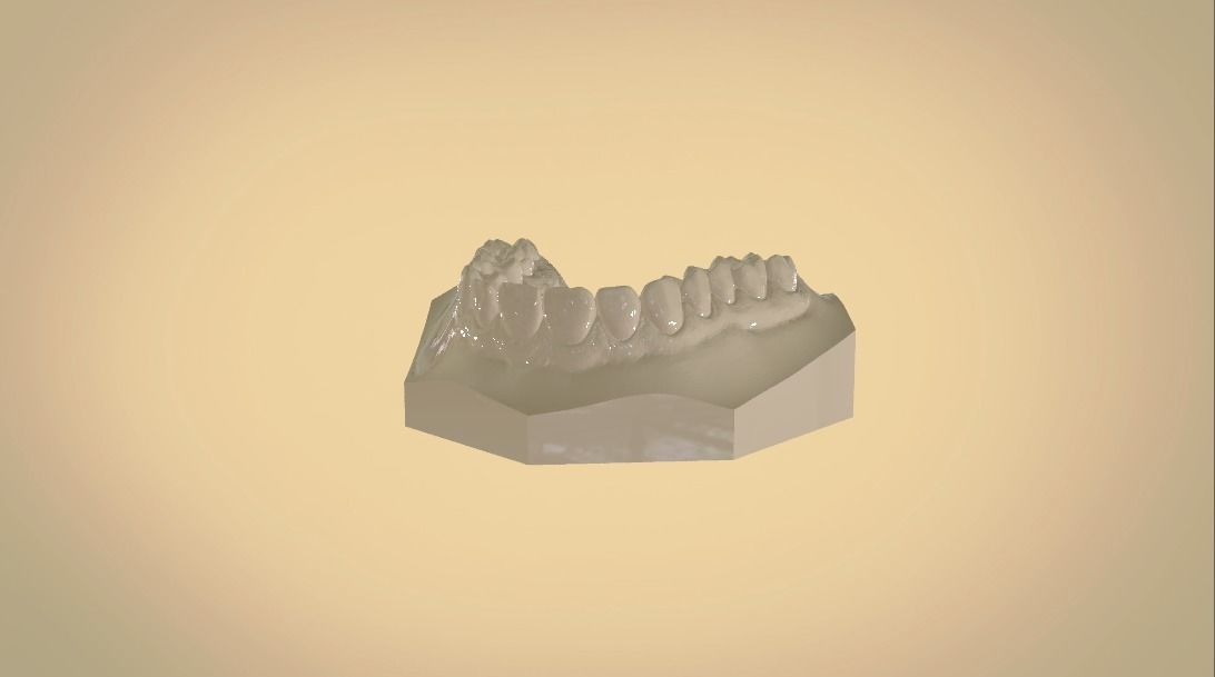 Digital Orthodontic Study Models with Virtual ABO Bases 3D print model_7