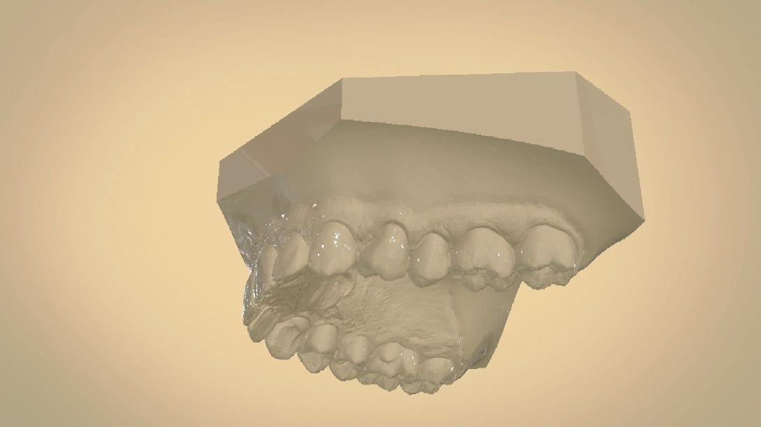 Digital Orthodontic Study Models with Virtual ABO Bases 3D print model_5