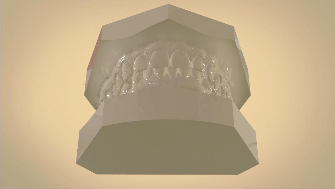 Digital Orthodontic Study Models with Virtual ABO Bases 3D print model_9