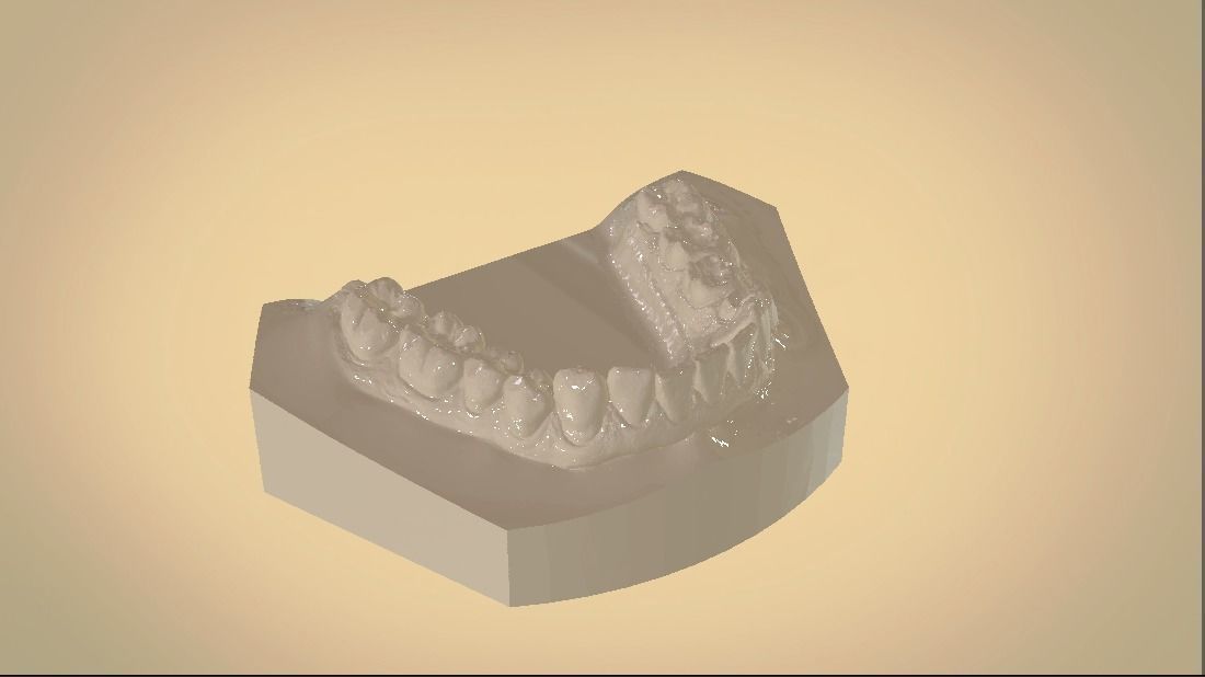Digital Orthodontic Study Models with Virtual ABO Bases 3D print model_11
