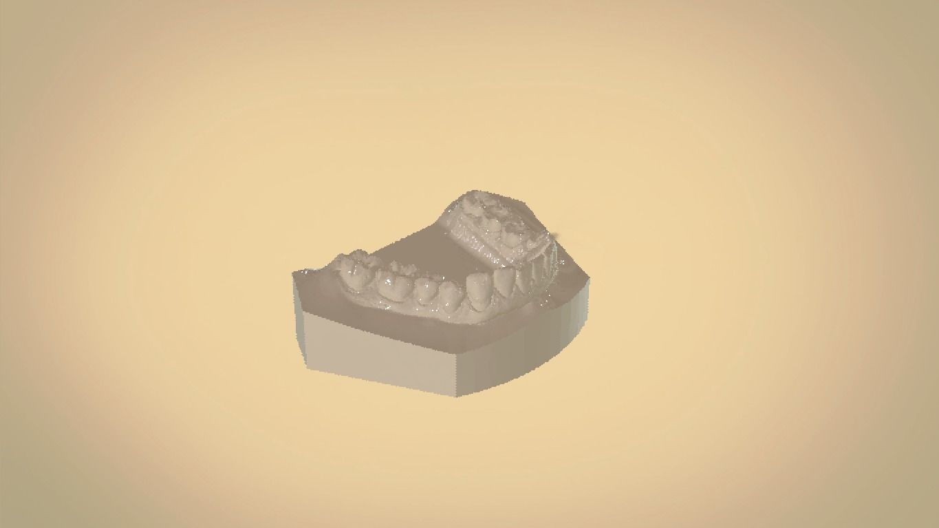 Digital Orthodontic Study Models with Virtual ABO Bases 3D print model_12