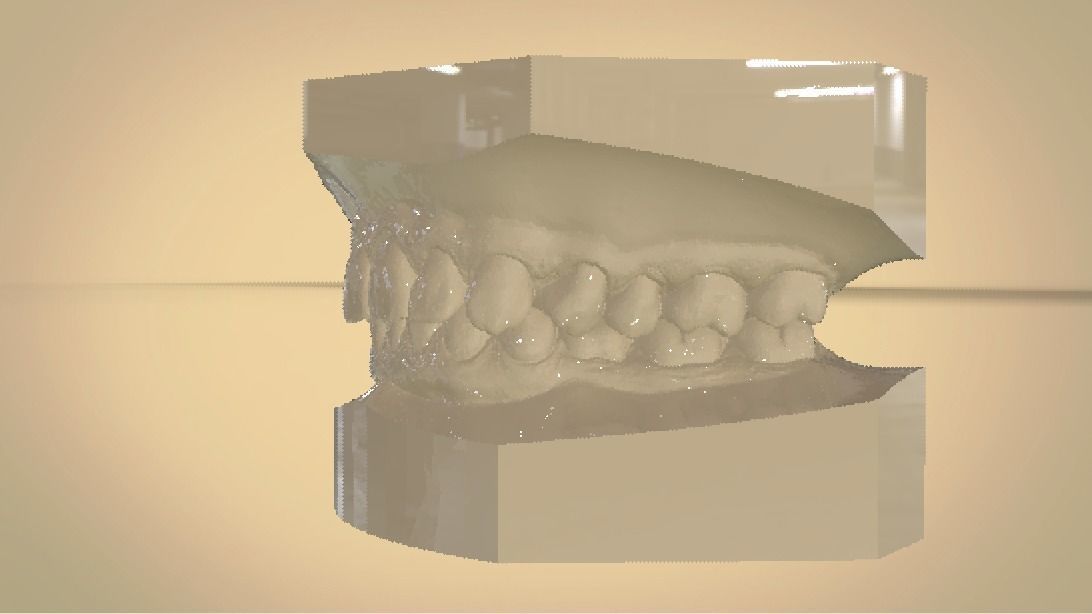Digital Orthodontic Study Models with Virtual ABO Bases 3D print model_6