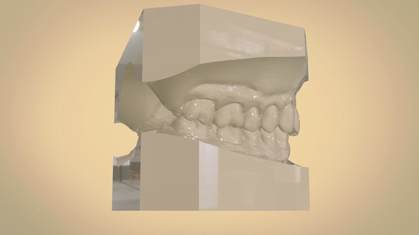 Digital Orthodontic Study Models with Virtual ABO Bases 3D print model_18