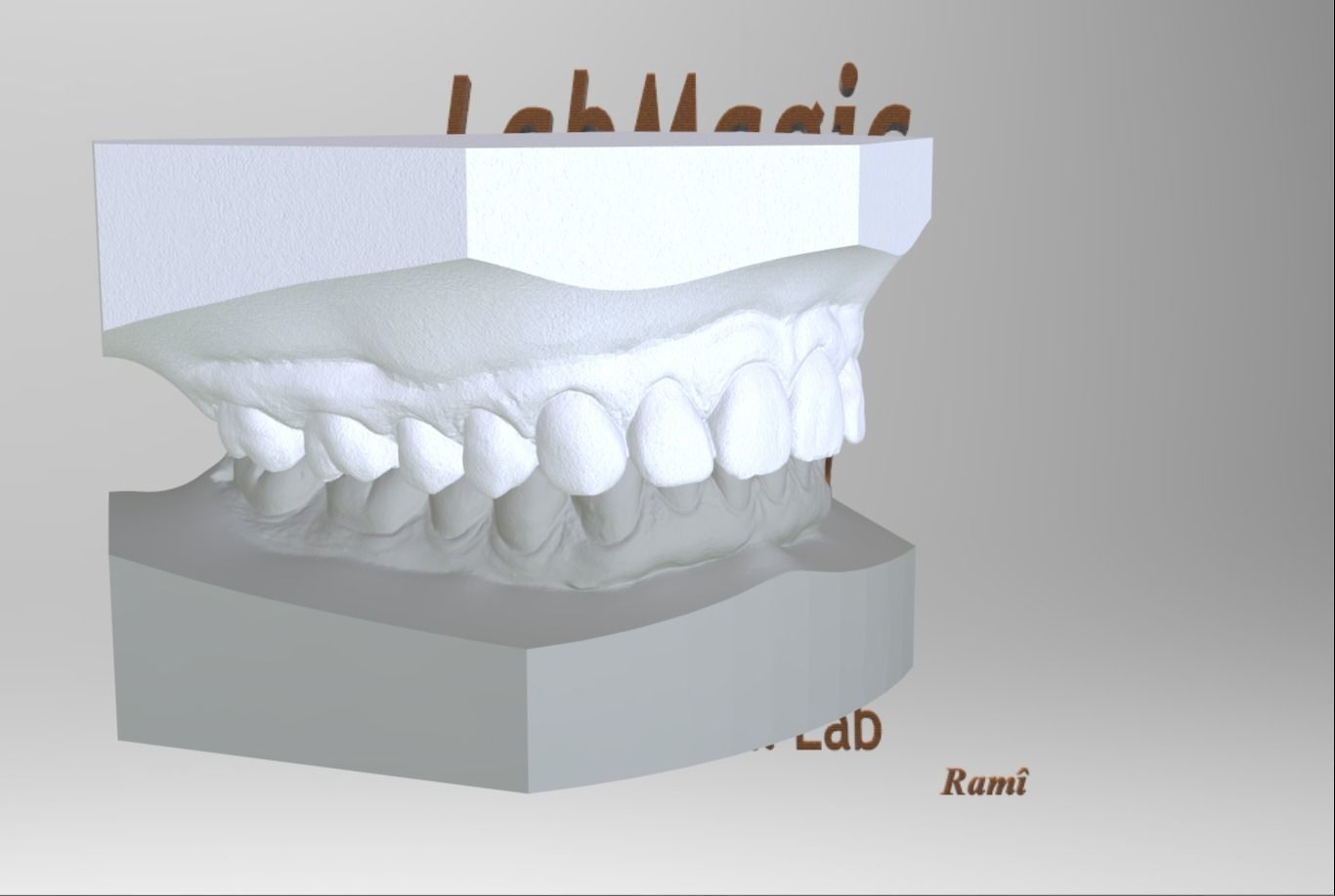 Digital Orthodontic Study Models with Virtual ABO Bases 3D print model_25