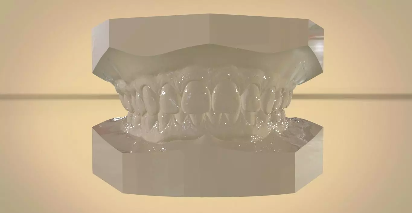 Digital Orthodontic Study Models with Virtual ABO Bases 3D print model_0
