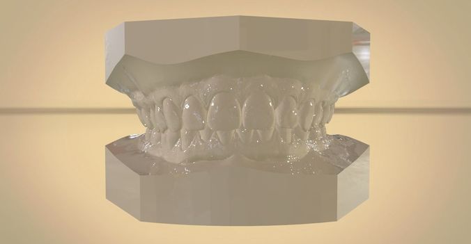 Digital Orthodontic Study Models with Virtual ABO Bases 3D print model