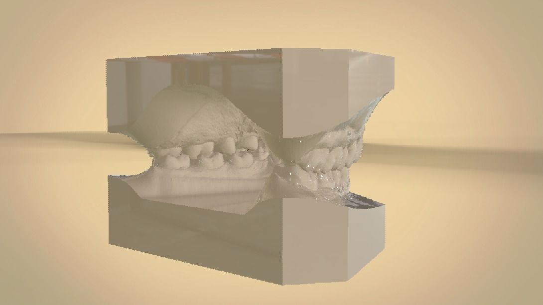 Digital Orthodontic Study Models with Virtual ABO Bases 3D print model_8