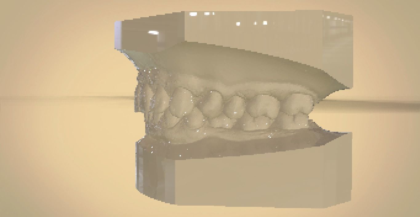 Digital Orthodontic Study Models with Virtual ABO Bases 3D print model_16