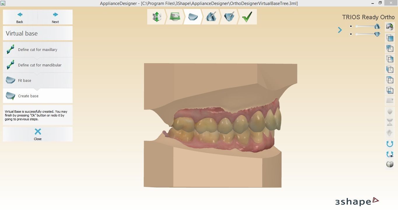 Digital Orthodontic Study Models with Virtual ABO Bases 3D print model_3