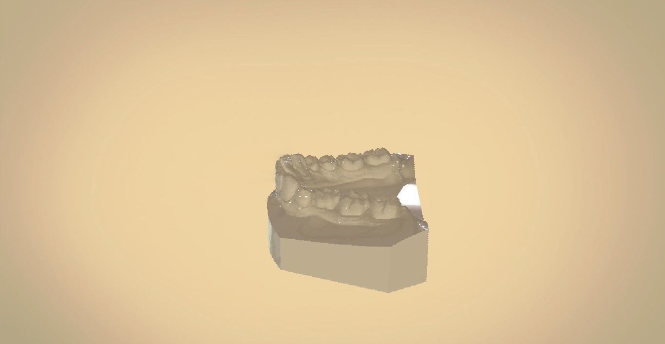Digital Orthodontic Study Models with Virtual ABO Bases 3D print model_13