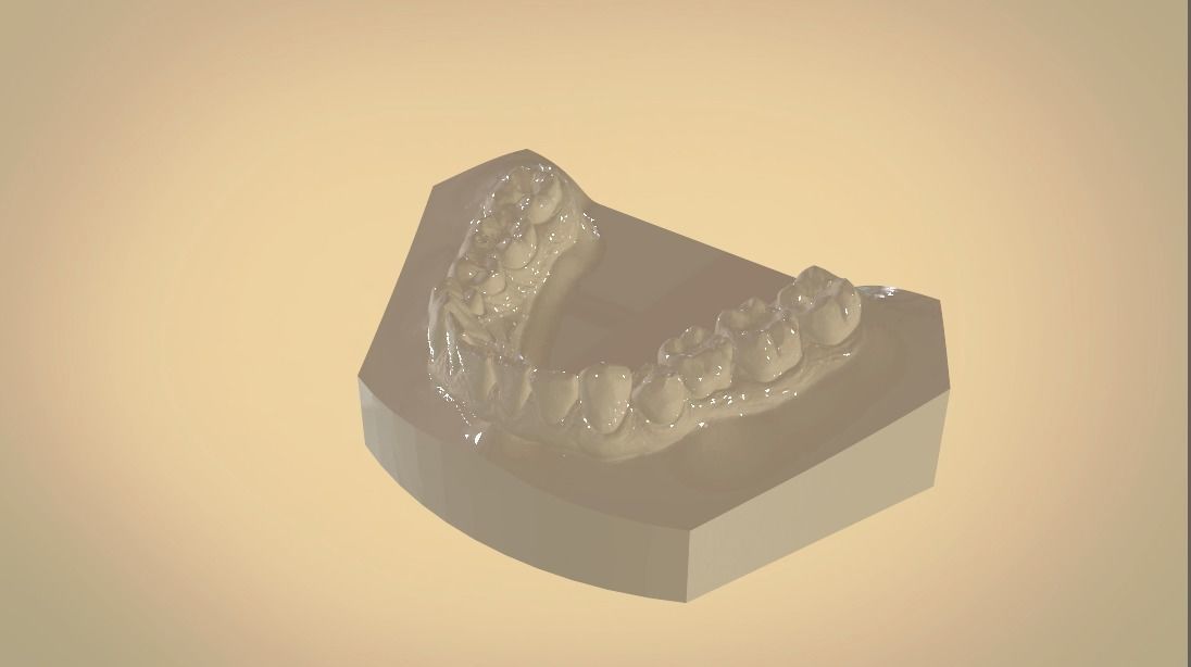 Digital Orthodontic Study Models with Virtual ABO Bases 3D print model_10