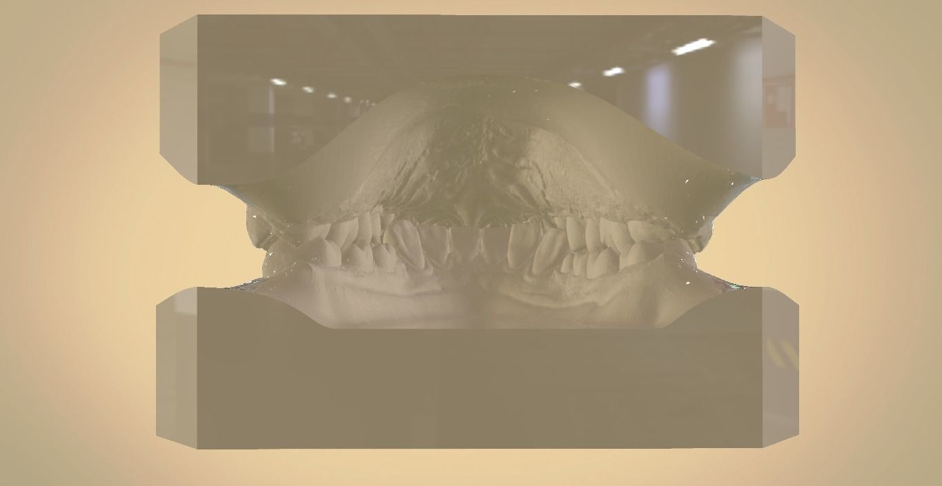 Digital Orthodontic Study Models with Virtual ABO Bases 3D print model_17