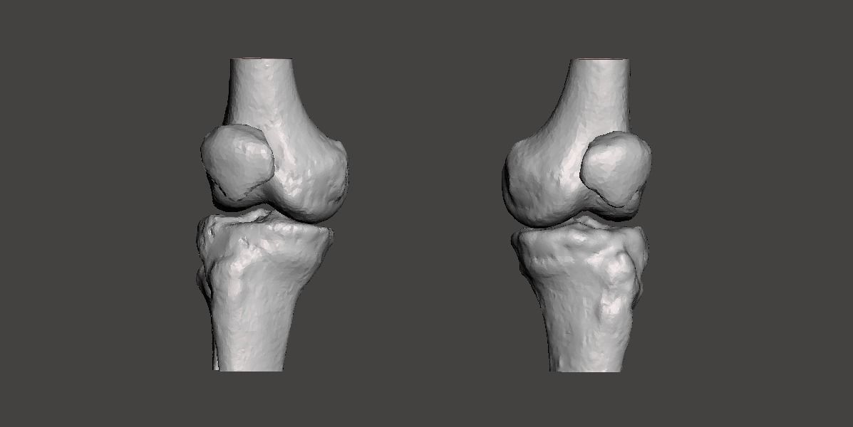 Knee joint - male - age 64 3D model_26