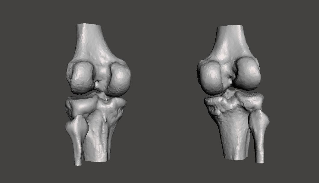 Knee joint - male - age 64 3D model_22