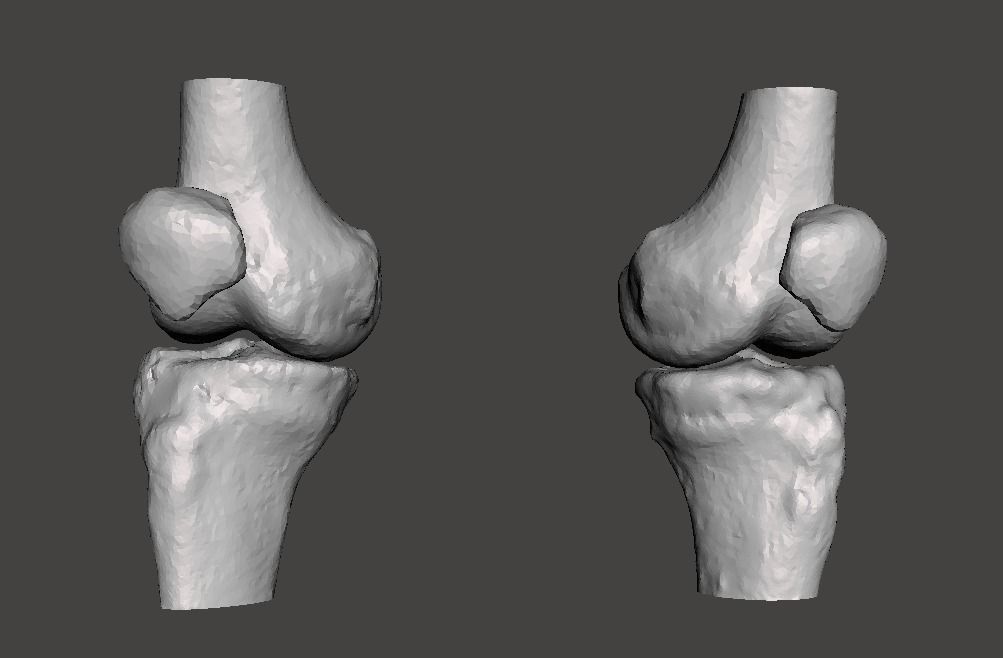 Knee joint - male - age 64 3D model_31