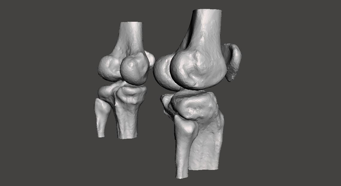 Knee joint - male - age 64 3D model_39
