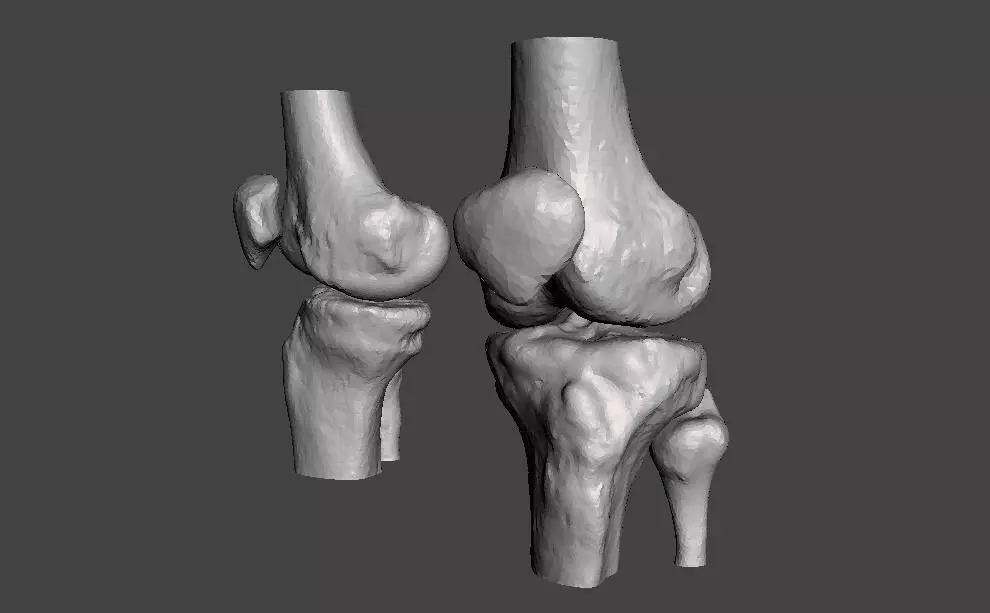 Knee joint - male - age 64 3D model_0