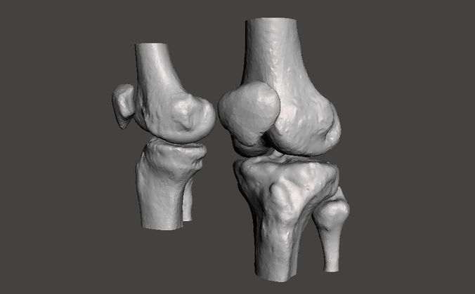 Knee joint - male - age 64 3D model