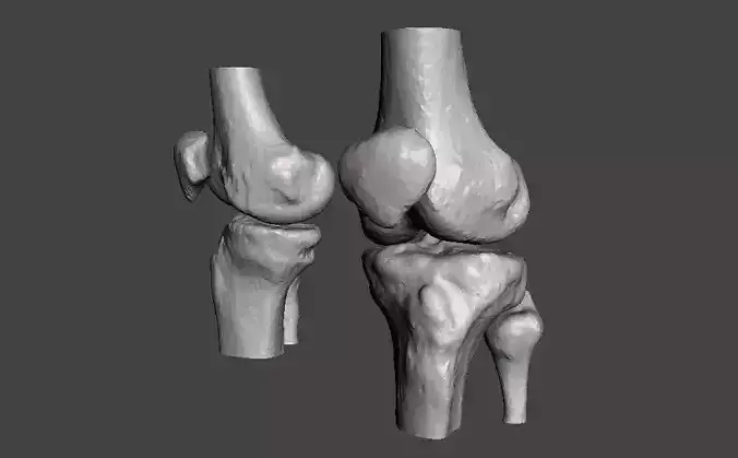 Knee joint - male - age 64 3D model