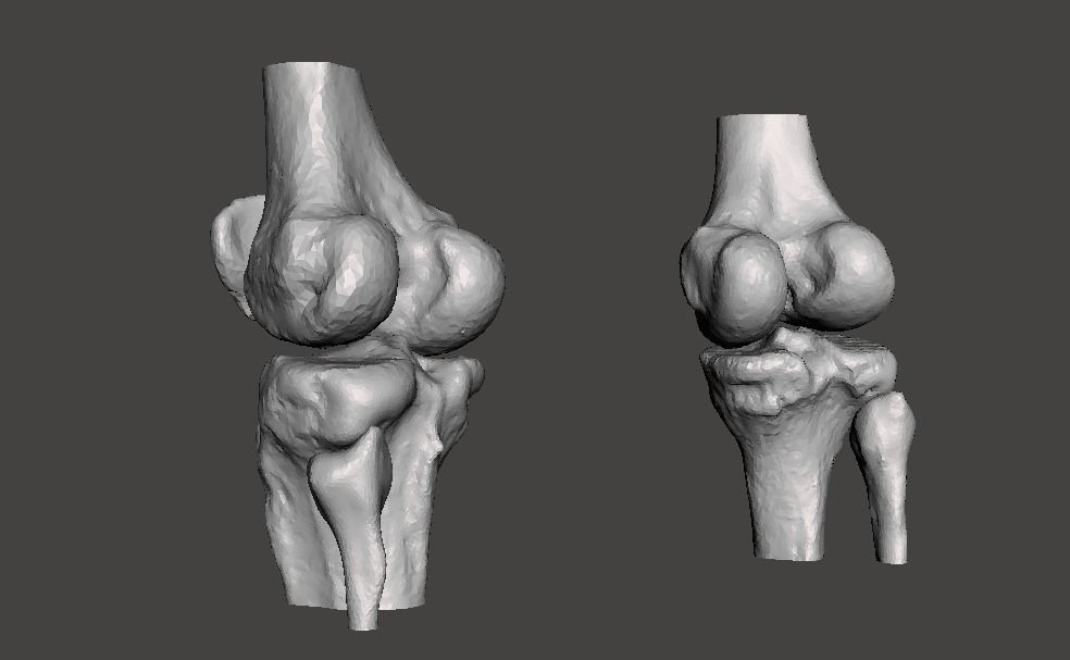 Knee joint - male - age 64 3D model_19