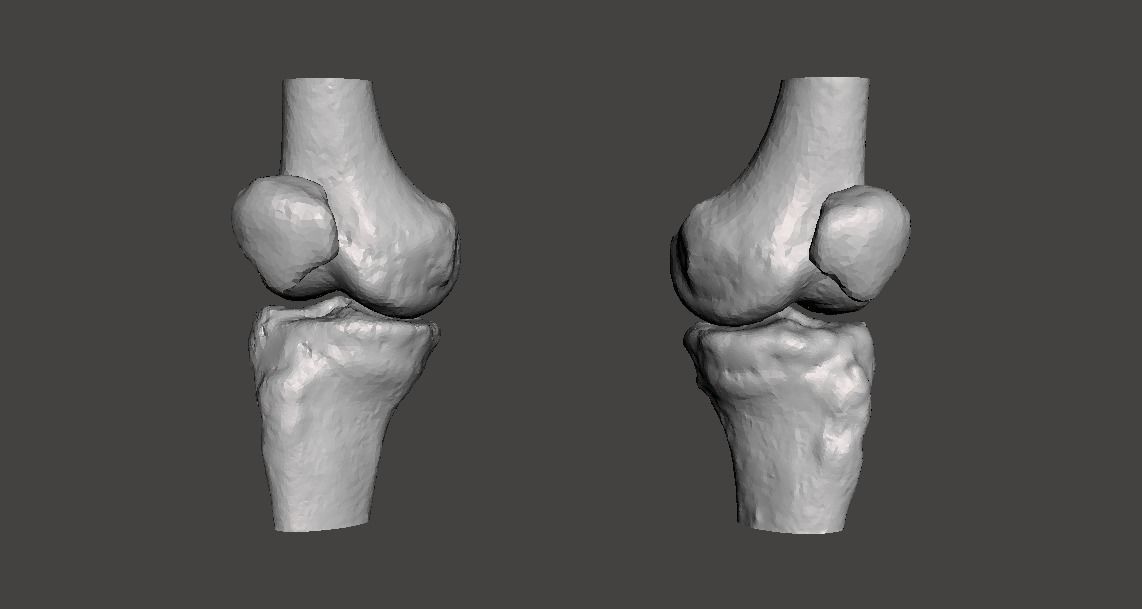 Knee joint - male - age 64 3D model_25