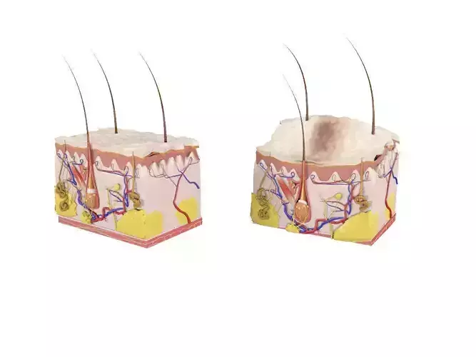 Skin layers Epidermis dermis Injections 3D model