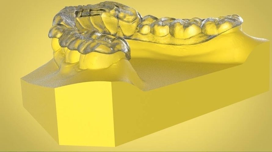 Digital Ortho Tanner Repositioner  3D print model_2