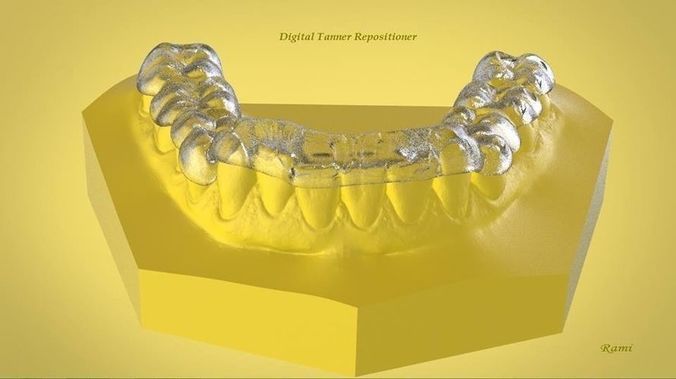 Digital Ortho Tanner Repositioner  3D print model
