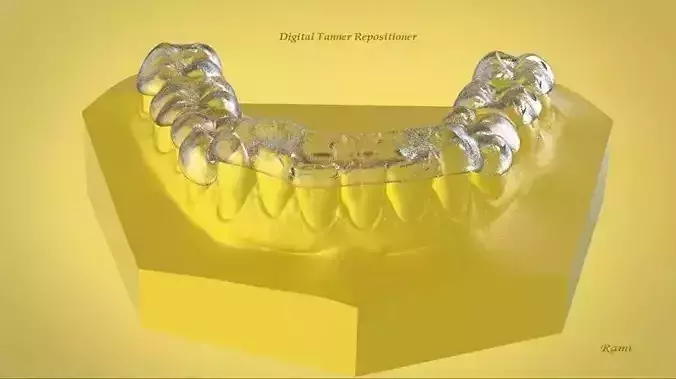 Digital Ortho Tanner Repositioner  3D print model