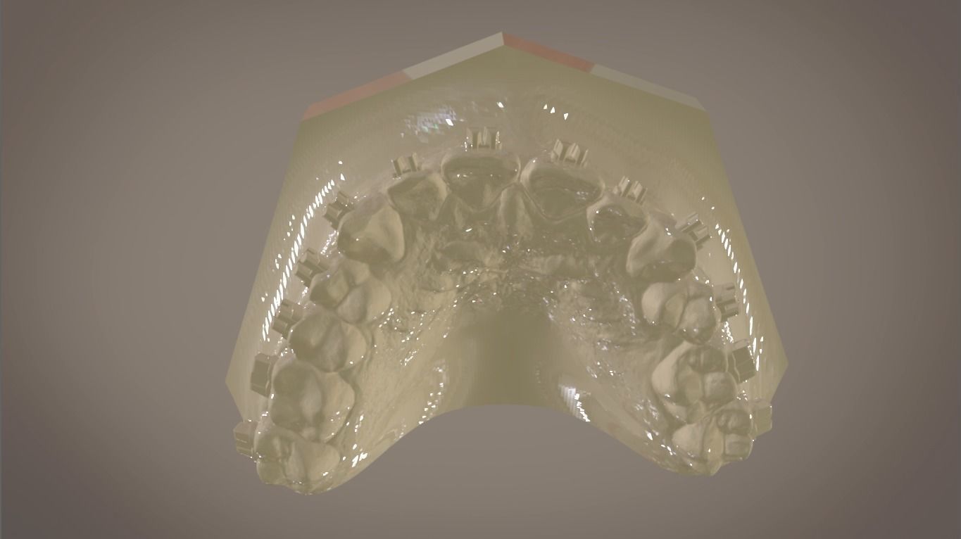 Digital Orthodontic Indirect Bonding Tray 3D print model_4