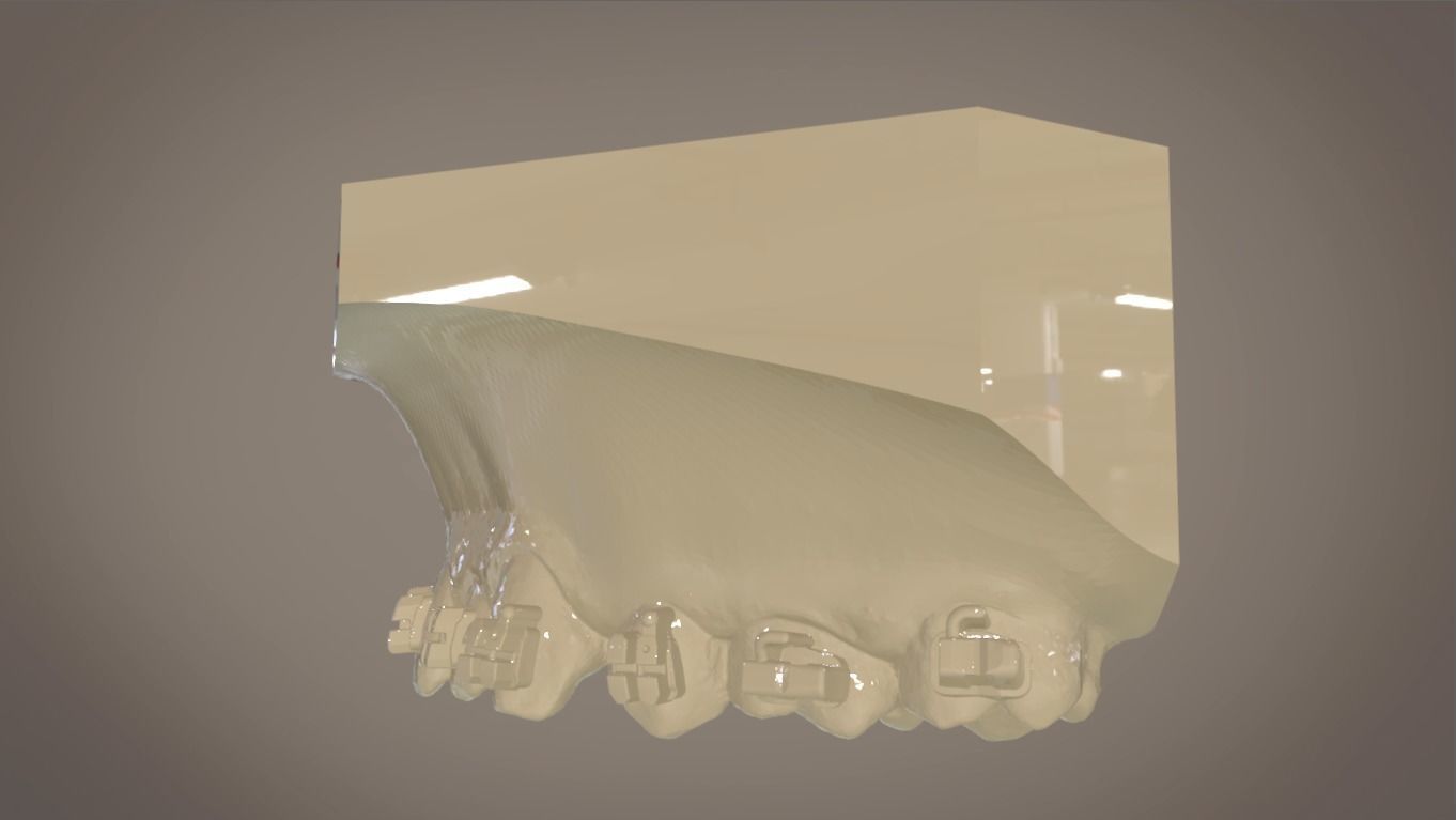 Digital Orthodontic Indirect Bonding Tray 3D print model_9