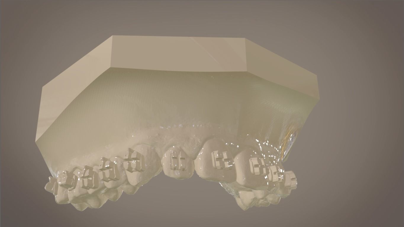 Digital Orthodontic Indirect Bonding Tray 3D print model_8