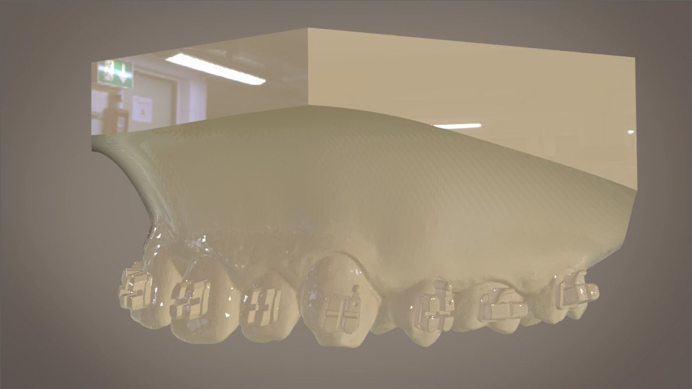 Digital Orthodontic Indirect Bonding Tray 3D print model_7