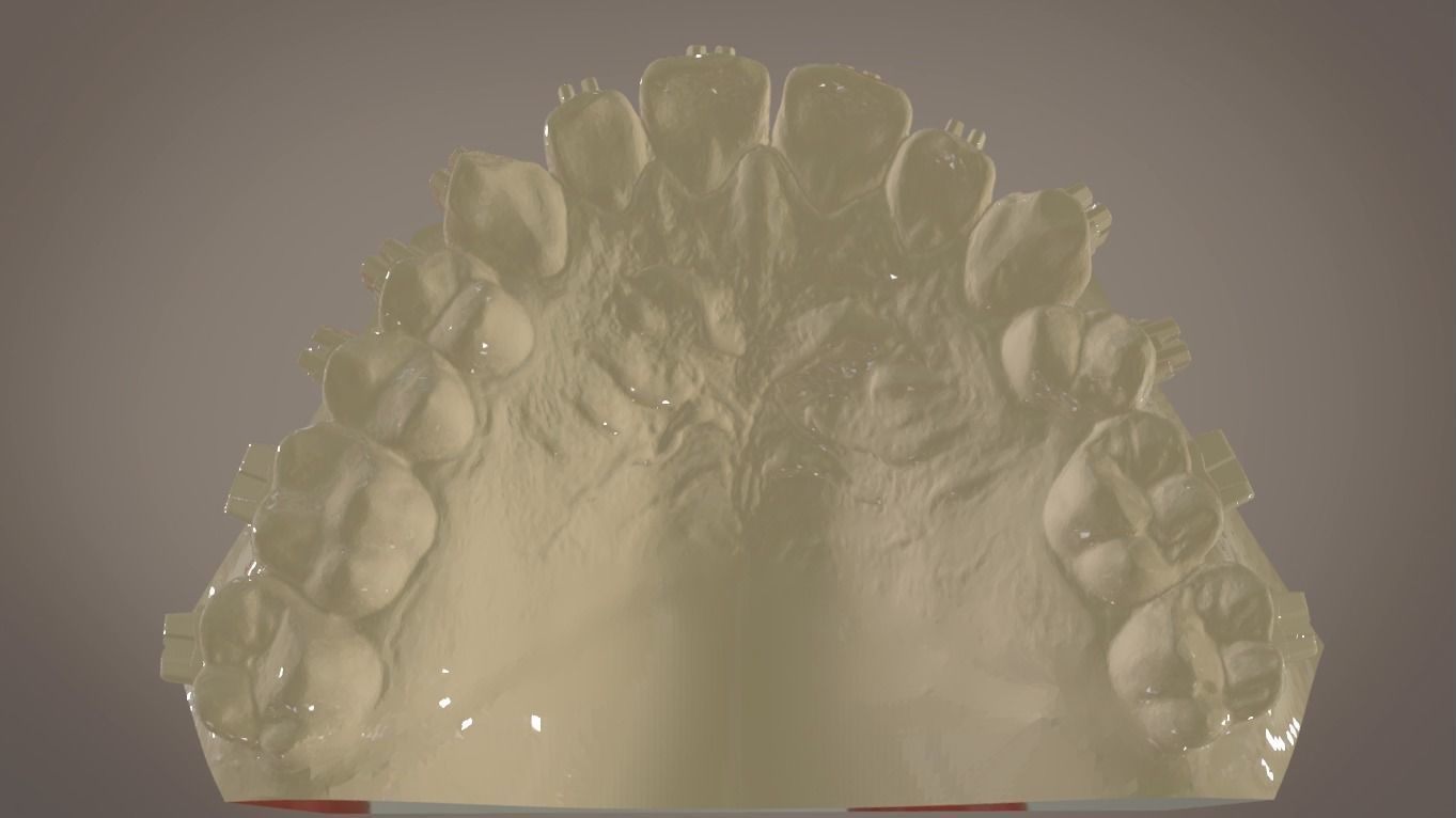 Digital Orthodontic Indirect Bonding Tray 3D print model_11