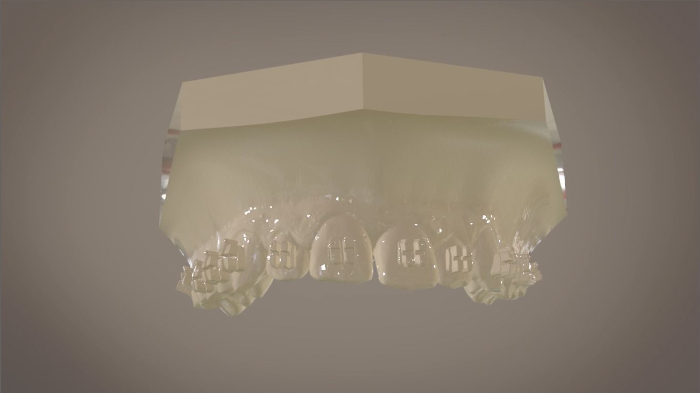 Digital Orthodontic Indirect Bonding Tray 3D print model_5