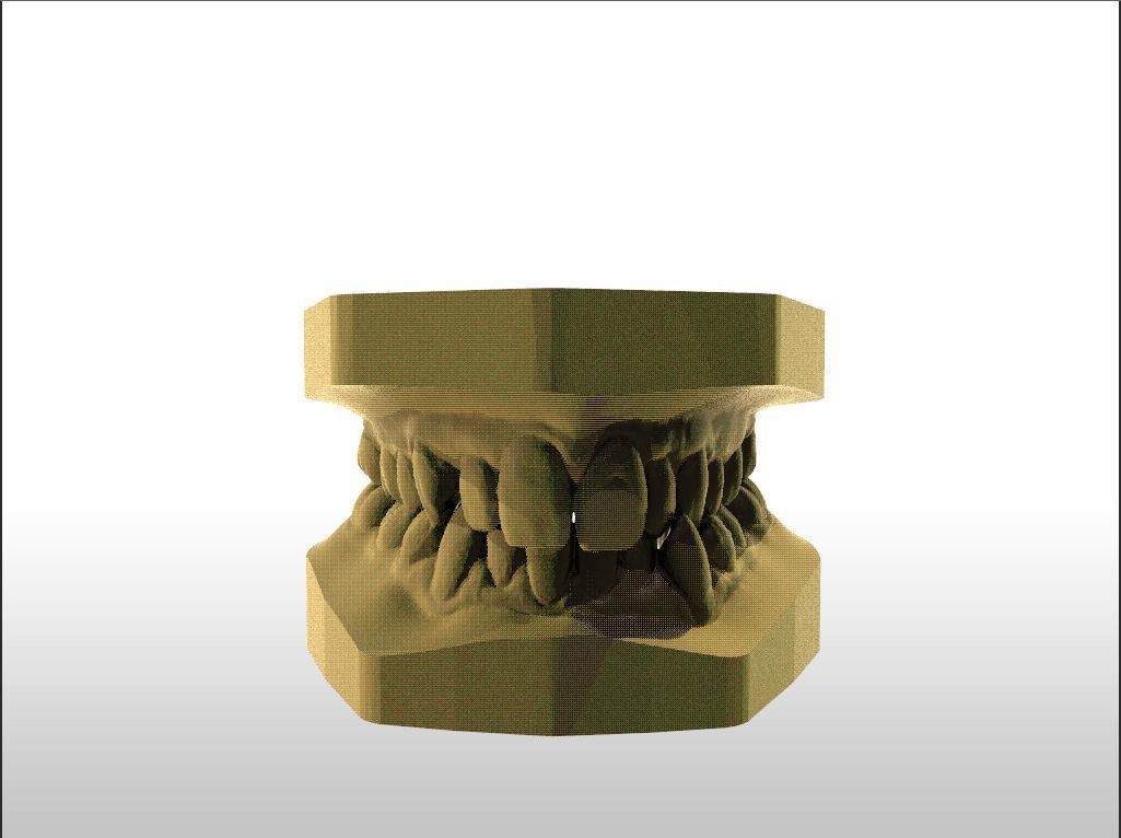 Digital Study Orthodontics Archman Models 3D print model_16