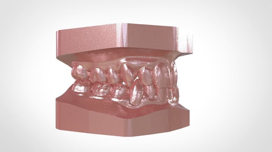 Digital Study Orthodontics Archman Models 3D print model_24