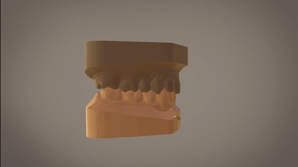 Digital Study Orthodontics Archman Models 3D print model_8