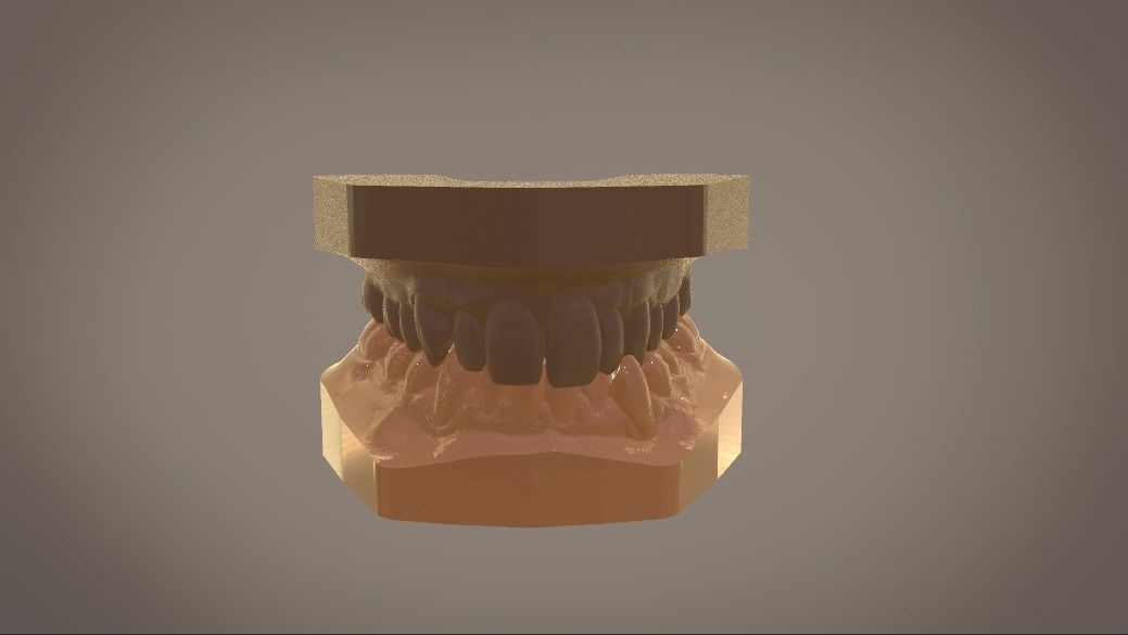 Digital Study Orthodontics Archman Models 3D print model_3
