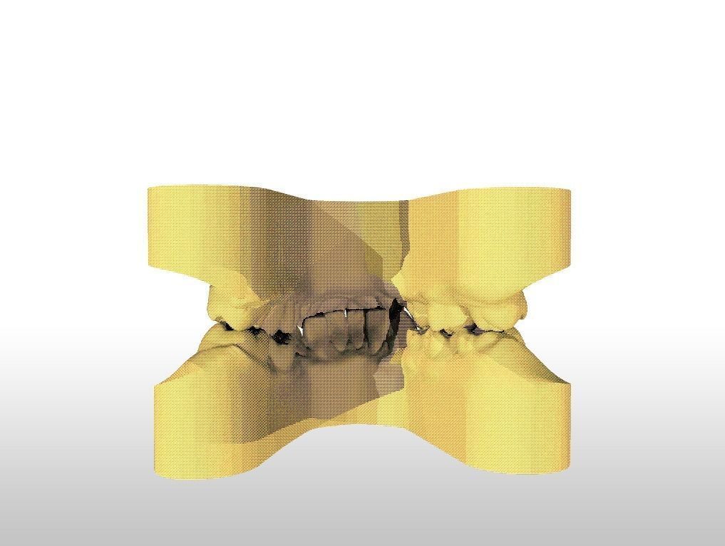 Digital Study Orthodontics Archman Models 3D print model_19