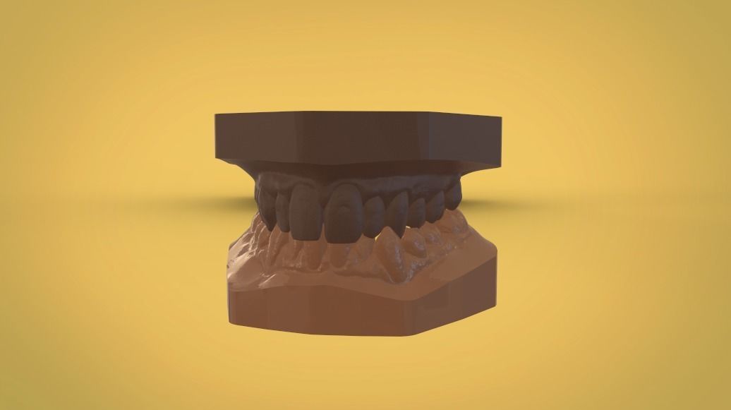 Digital Study Orthodontics Archman Models 3D print model_7