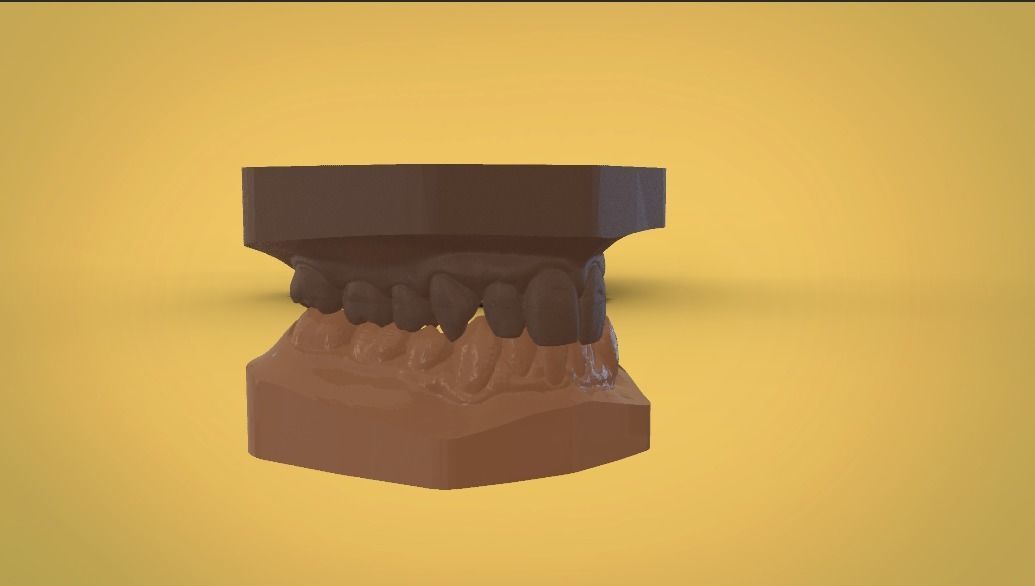 Digital Study Orthodontics Archman Models 3D print model_4