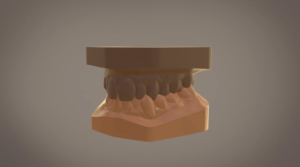 Digital Study Orthodontics Archman Models 3D print model_5
