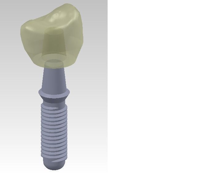 dental prosthesis Free 3D model